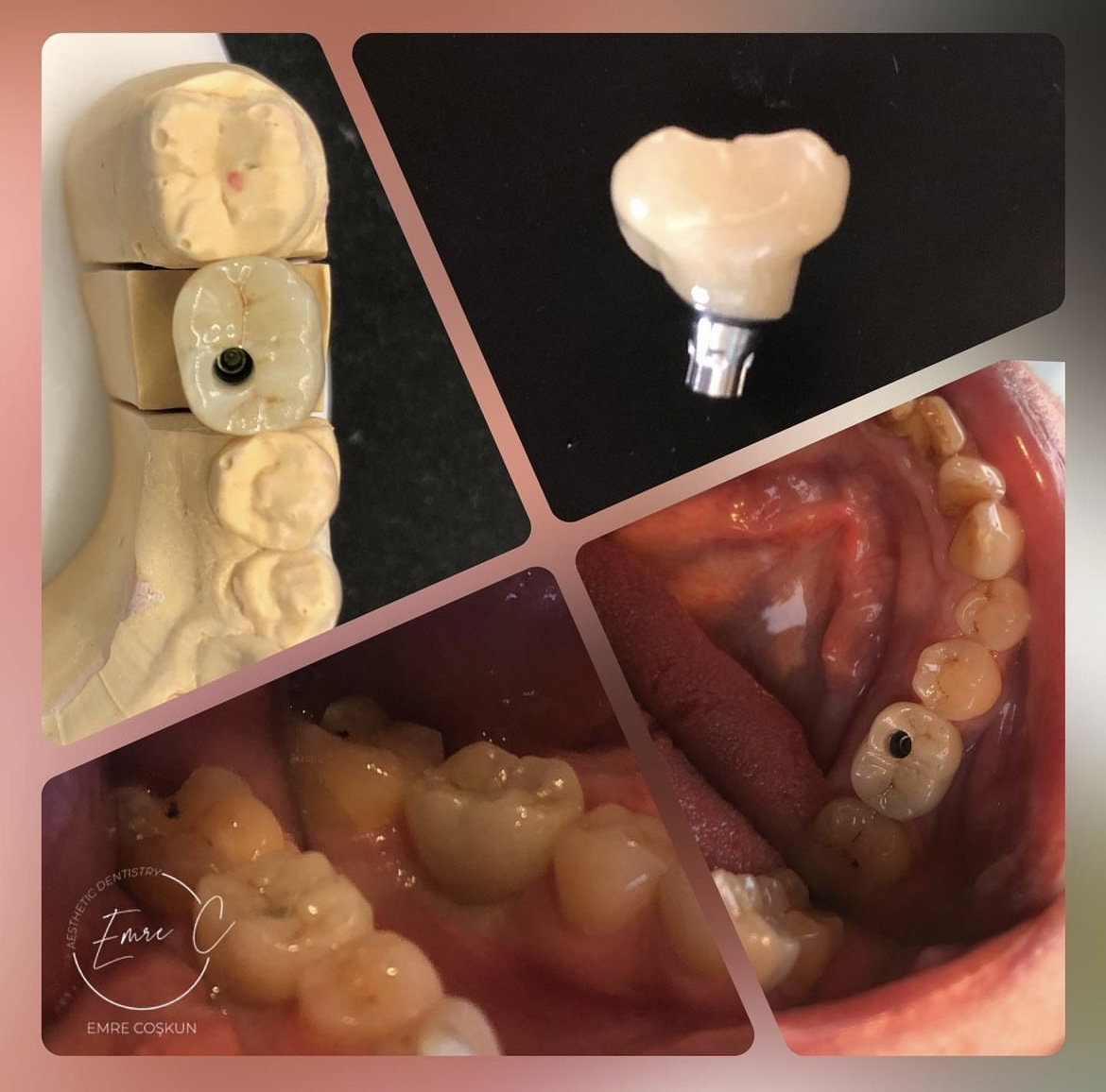Screw retained crown